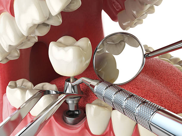 Best Emergency Root Canal Treatment in Hopewell, VA